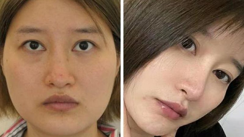 肉毒素面部提升：揭秘前后对比图背后的秘密