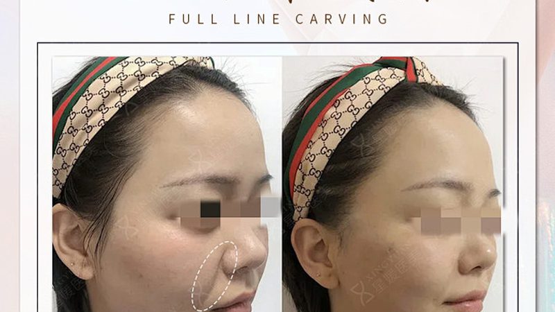 北京激光脱毛前后对比：揭秘真实效果与注意事项