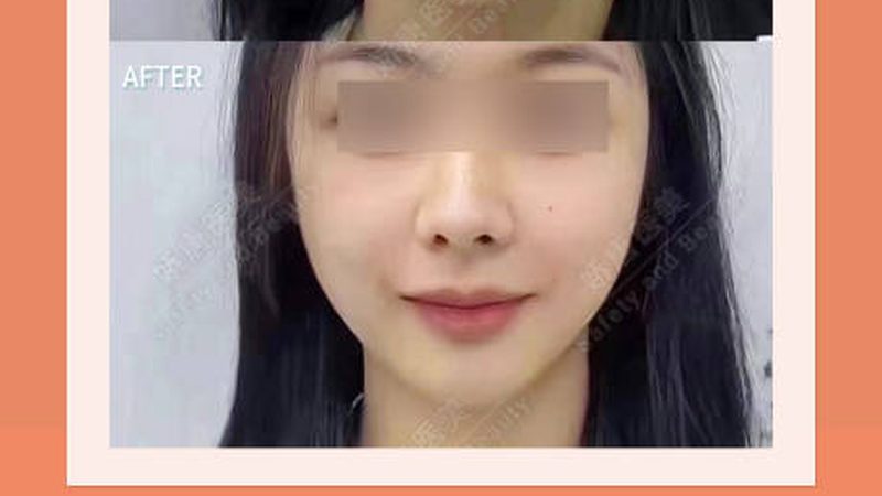 热玛吉仪器报价单揭秘：如何识别正规与陷阱