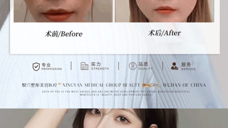 成都轻医美激光祛斑：揭秘其优缺点，助你理性选择